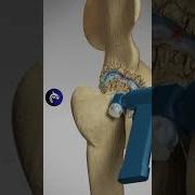 Total Hip Replacement Arthroplasty 3D Animation