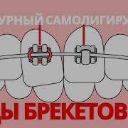 Какие ВЫБРАТЬ БРЕКЕТЫ Лигатурные Vs самолигирующиеся