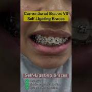 Conventional Braces Vs Self Ligating Braces Which One Should You Choose