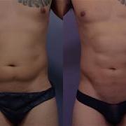 3 D Liposuction Abdominal Sculpting At Stoker Plastic Surgery