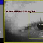 Horizontal Head Shaking Test Nystagmus 001