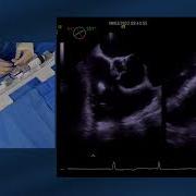 Tricuspid Edge To Edge Repair With The Pascal Device
