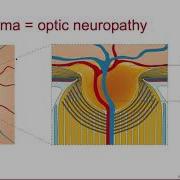 4 2 Primary Open Angle Glaucoma Clinical Manifestations Diagnosis