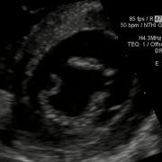 AV Canal Defect With A Gerbode Type VSD And Cleft Mitral Valve