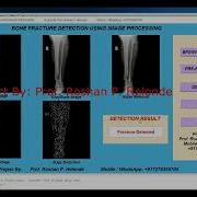Detection Of Bone Fracture Using Image Processing Matlab Project With Source Code Fracture Detection