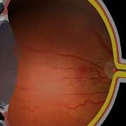Glaucoma