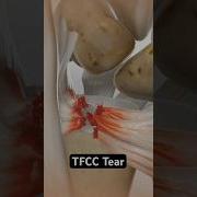 Wrist Pain Could Be A Tear 3D Animation