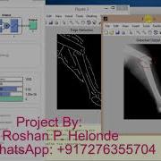 Bone Fracture Detection Using Neural Network Matlab Project Code