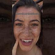 Freckles Before And After Freckles
