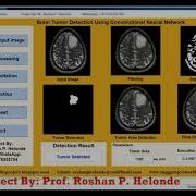 Matlab Source Code For Brain Tumor Detection Using Convolutional Neural Network CNN