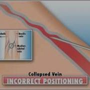 Collapsed Vein