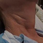 Regular Carotid Pulsation And Discernible Internal Jugular Venous Pulse