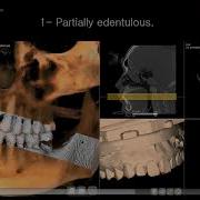 Matching Aligning STL Models With CBCT Scan Partially Edentulous Protocol