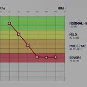 Hear Com How To Read An Audiogram