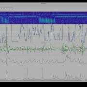 Scoring Sleep With ZMax 2 Variations In The Spectrogram