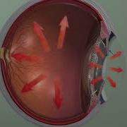 Audio Description Animation Glaucoma