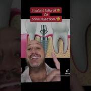What About Implant Failure Or Bone Rejection WHICH ONE IT IS