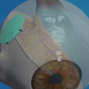 Glaucoma Animation Implant Surgery