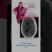 Diagnostics On Demand Subdural Hematoma