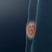 Understanding Psoriasis