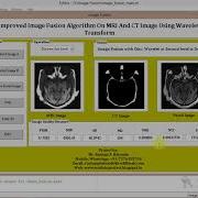 Image Fusion On MRI And CT Image Using Matlab Project Code