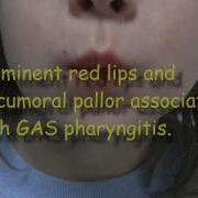 Strep Throat And Scarlet Fever