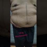 Megaliposuction Under Local Anesthesia Short Short Shortvideo Shorts