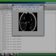 Lung Pattern Classification For Interstitial Lung Diseases Final Year Projects 2016 2017