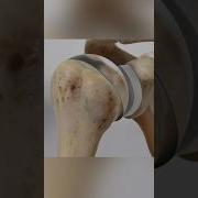 Total Shoulder Replacement 3D Animation