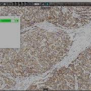 3DHISTECH Her2stain Quantification Using PatternQuant And MembraneQuant
