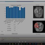 Brain Tumor Detection Using Different Machine Learning Algorithm Using MATLAB MATLAB Solutions