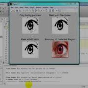 Iris Segmentation Method Of Pterygium Anterior Segment Photographed Image