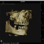 Implant Planning With ACTEON Imaging Suite