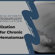 Embolization Methods For Chronic Subdural Hematomas