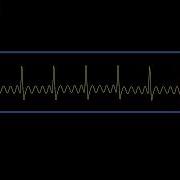 Aflutter Waveform Simulated Patient Waveform