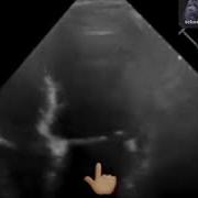 Side Lobe Artifacts