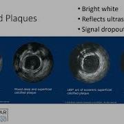 IVUS Guided PCI Step By Step Seto Coronary On Demand