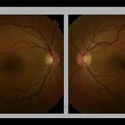 The Practical Approach To The Glaucoma Suspect