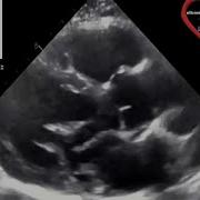 Side Lobe Artifact