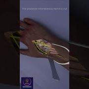 Wrist Fusion Surgery Shorts