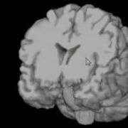 MRIcroGL 3D Brain Visualization