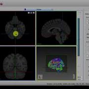 MI Brain Cut All Tract Segments Inside A Region Of Interest