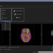CBICA CaPTk Recurrence Estimation Of Glioblastoma