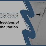 Future Directions Of MMA Embolization
