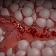 Sickle Cell Anemia