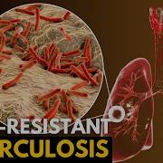 Tuberculosis Causes Signs And Symptoms Diagnosis And Treatment