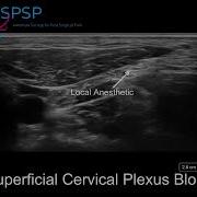 Ultrasound Guided Superficial Cervical Plexus Block
