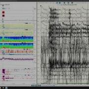 Using Persyst 14 In The EMU With Dr Mark Scheuer