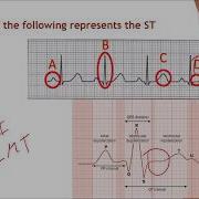 NHA Module 13 EKG And Cardiovascular Testing Q A