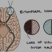 Understanding Bitemporal Hemianopia